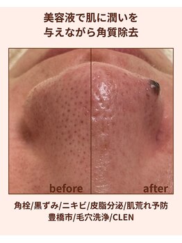 クレン(CLEN)/毛穴洗浄/ブライダル/美白