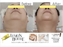 レモンボトル3cc×エンダ2回◎顎下脂肪、眼窩脂肪もスッキリ