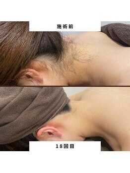 ミース 自由が丘店/うなじ矯正◆ビフォーアフター