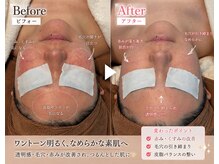 アイラブワン 大和 南林間店(eye love one)/光フォト×ララピール【毛穴】
