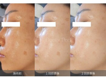 Lio.【リオ】刈谷店 【マツエク|毛穴|シミ|ピーリング|肌管理専門店】の写真/【韓国で話題の最新ピーリング】★ダクトピール★毛穴|シミ|くすみ|を徹底ケア★ダウンタイムなし◎