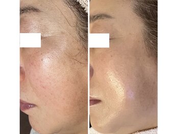 エソア(esoa)の写真/【医療提携×看護師×たるみケア】ほうれい線・毛穴・ハリ不足に◎お肌の土台からふっくらハリツヤ肌へ♪