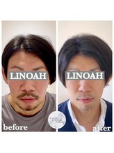 リノア 心斎橋店(LINOAH)/ウルトラプラス小顔リフト b→a