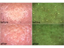 ベベ 目黒店(Be'be')/肌表面と皮脂のビフォーアフター