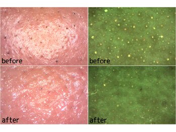 ベベ 目黒店(Be'be')/肌表面と皮脂のビフォーアフター