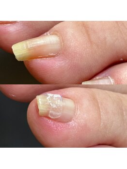 リリ(lili)/巻き爪矯正1回目(左薬指)