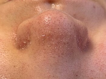 マイナプラ 表参道(myna+)の写真/皮脂詰まり・黒ずみを集中ケア!【プレミアム毛穴洗浄♪３STEPハイドラフェイシャル＊徹底毛穴ケア¥10800】