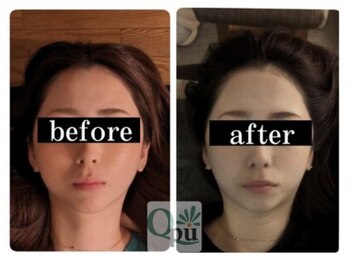 キュープ 下関店(Qpu)/通常コース4回での変化