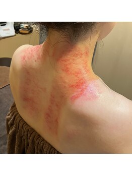 ソルーナ(So-Luna)/カッサ療法