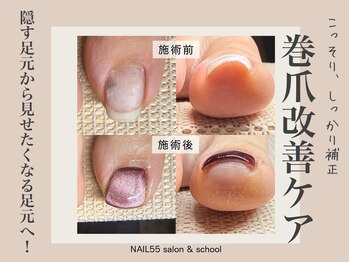 ネイルゴーゴー(NAIL55)/巻き爪改善ケア！