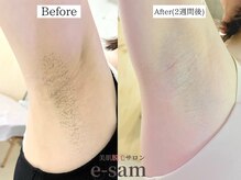 イーサム 高槻摂津富田店(e-sam)/ ワキ脱毛