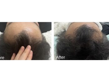 ミニョン(mignonn.)/【EXO育毛促進】