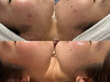 ティアラッシュ(TiaLash)/月1回のハーブピーリング