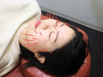 もりわき骨盤鍼灸整骨院 梅田院の写真/内側からハリ感のある艶肌へ★【美肌美容鍼+電磁パルス¥5500】小顔・ほうれい線・シミ改善・たるみケア◎