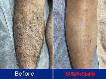 ミスターアンクール 鹿児島(Mr.uncoeur)/足脱毛6回後
