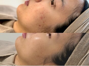 ピブ(PIBU)/ニキビ症例/ハーブピーリング