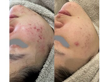 アイアール(ir)/ハイドラ×レチノール