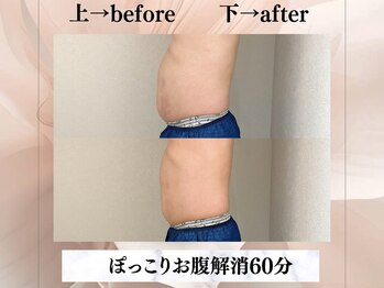 イヨヨ(iyoyo)/【痩身】Before After