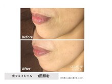 モイ(Moi’e)/リフトアップ・ハリ・シミ