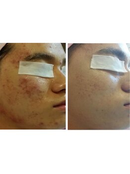 ナビ(NAVI)の写真/<メンズ大歓迎◎>メンズも肌管理の時代。男性特有の肌悩みをプロが徹底サポート&本格改善!