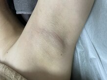 ナノハナ/鹿沼市全身脱毛美容室ナノハナ