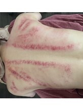 メディカル整体院/オプション☆かっさ20分コース