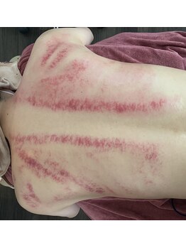 メディカル整体院/オプション☆かっさ20分コース