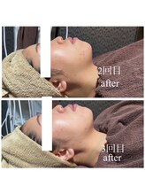 ラクラク(rakuraku)/リフトアップフェイシャル【女】