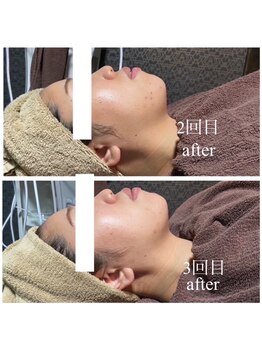 ラクラク(rakuraku)/リフトアップフェイシャル【女】