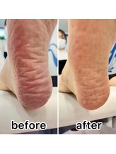 サニーヒルズ ウィズ マキア 藤沢(Sunny hills with MAQUIA)/フット角質スペシャルケア