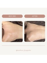 エミルカ 自由が丘店(EMILUCA)/ハーブピーリング背中ケア