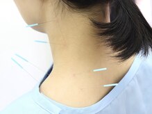 とだ鍼灸院/《鍼灸施術》首肩レスキュー鍼灸