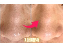 ロジュマンアンドクレア(LOGEMENT&Crea.)/小鼻の毛穴洗浄