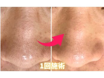 ロジュマンアンドクレア(LOGEMENT&Crea.)/小鼻の毛穴洗浄