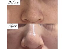 ノエル(NOEL)/鼻の黒ずみ毛穴汚れ比較