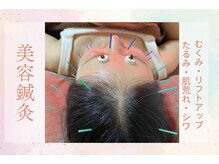 美顔鍼灸で肩首もケア♪リフトUP・乾燥・たるみ・むくみに◎