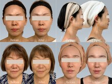 バウムユー 銀座店(baum.u)の雰囲気(引き締め/毛穴縮小/ハリUP【その他の症例はフォトギャラリーへ】)