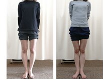 たどころ整骨院/お客様の変化/O脚矯正