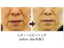 肌に透明感が出て美白ケアにも◎嬉しい毛穴縮小効果もあり◎