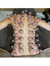 ソルーナ(So-Luna)/カッピング（吸玉）