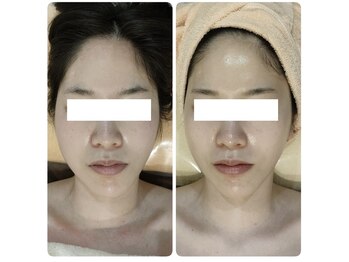 ルノン(Lunon)/《整顔》winbackフェイシャル