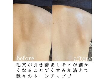 エムラボ 麻布十番店(M LABO)/背中ハーブピーリング