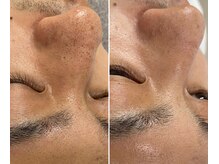 アヌエヌエ(aNueNue)/毛穴ケア