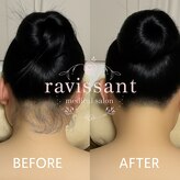 ラヴィソン(ravissant)