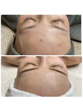 ニナル(ninal)/プラズマ+ハーブピーリング