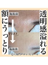 ピュール 鯖江店(PUR)/毛穴/毛穴ケア/毛穴洗浄