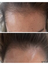 ミニョン(mignonn.)/ふんわりトップ育毛促進