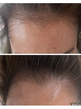 ミニョン(mignonn.)/ふんわりトップ育毛促進