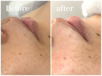 トリプルワン(111)/クラニオフェイシャルワックス