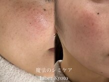 エステティック リベル キョウト 京都駅前店(Esthetic Liber Kyoto)/魔法のシミケア